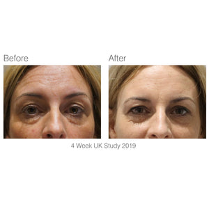 before and after 4 week study of eye and midface area with visibly reduced wrinkles more youthful skin after using facelite beauty boosting LED face mask