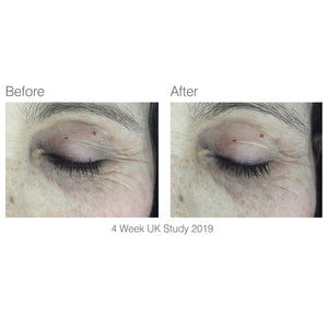 before and after 4 week study of eye area with visibly reduced wrinkles after using facelite beauty boosting LED face mask