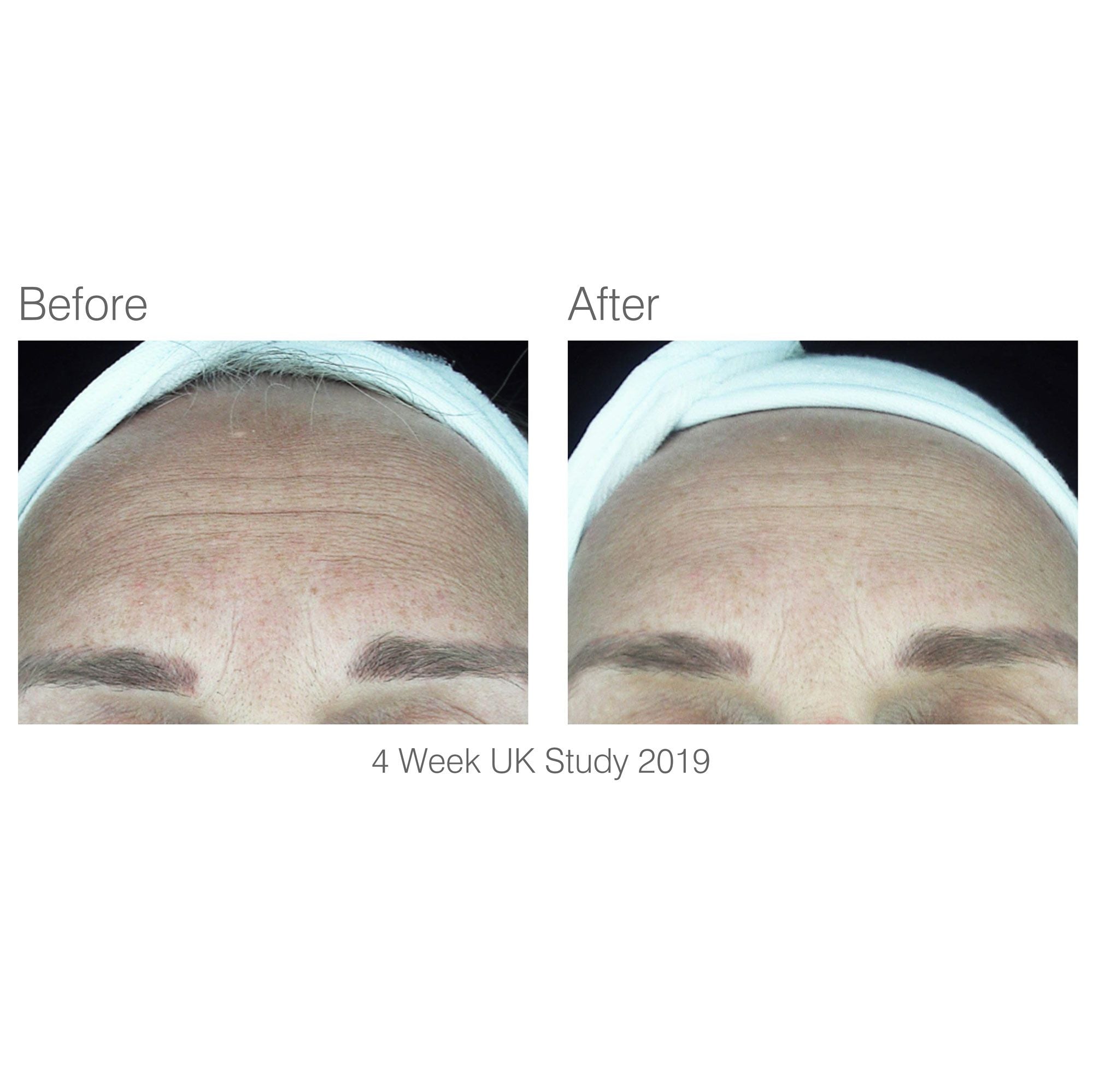 before and after 4 week study of forehead area with visibly reduced wrinkles after using facelite beauty boosting LED face mask