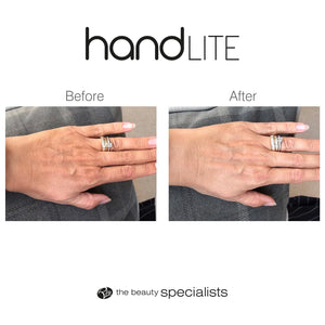 Before and After images showing the benefits of wearing the handLITE LED light treatment glove.