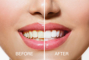before and after side by side image of smile with yellow discolouration on teeth and after of bright white smile